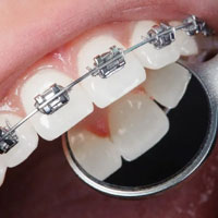 Dental-Braces