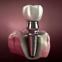 Dental-Implant