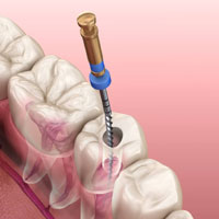 Root-Canal