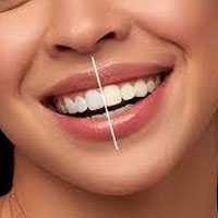 Teeth-Whitening