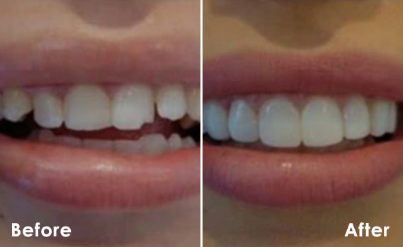 before-after-1