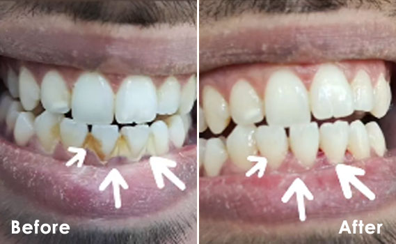 before-after-2