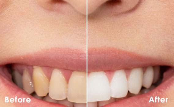 before-after-3