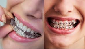 clear-aligner-braces-vs-traditional-braces