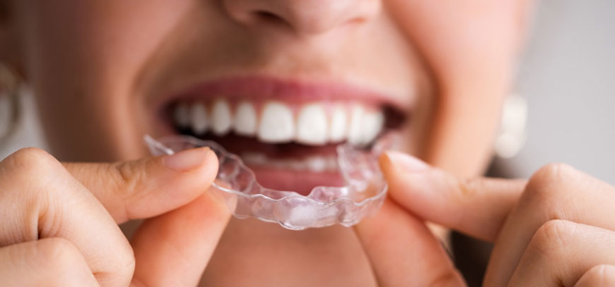 Aligners