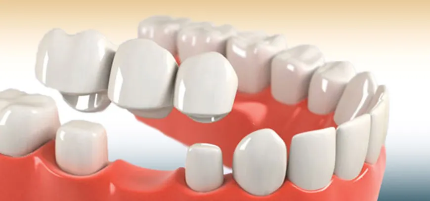 Crown-Bridge-Treatment