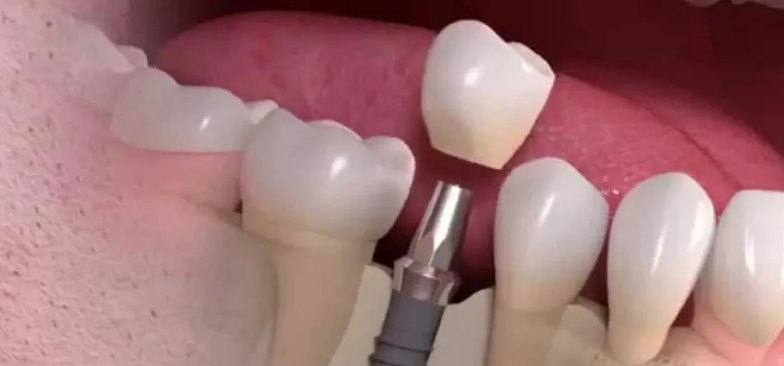 Dental-Implant