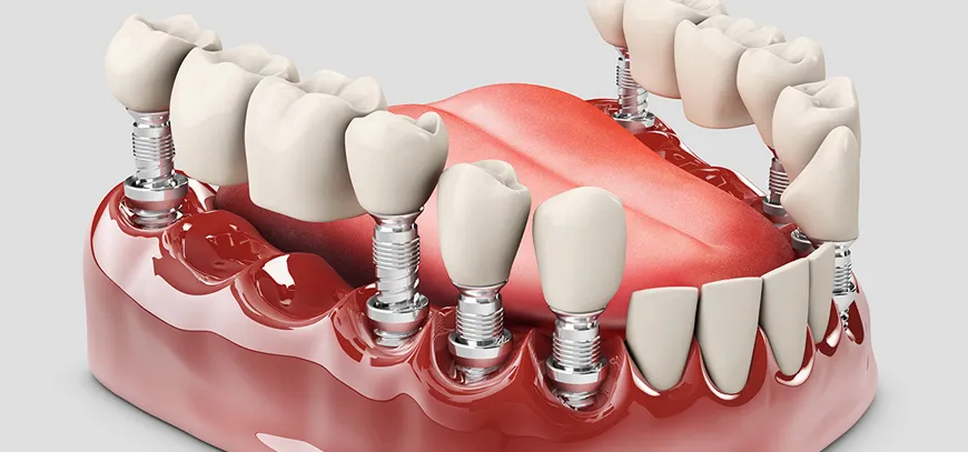 Dentures-Treatment