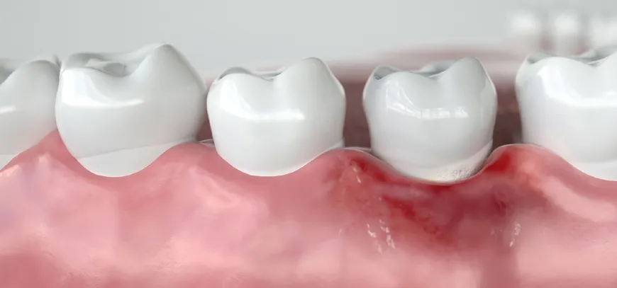 Gum-Surgery-Treatment