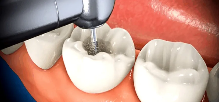 Root-Canal-Treatment