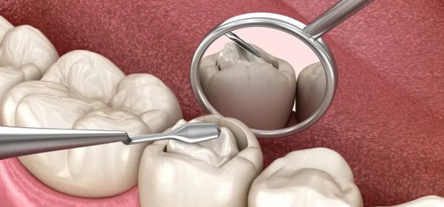 Teeth-Filling-Treatment