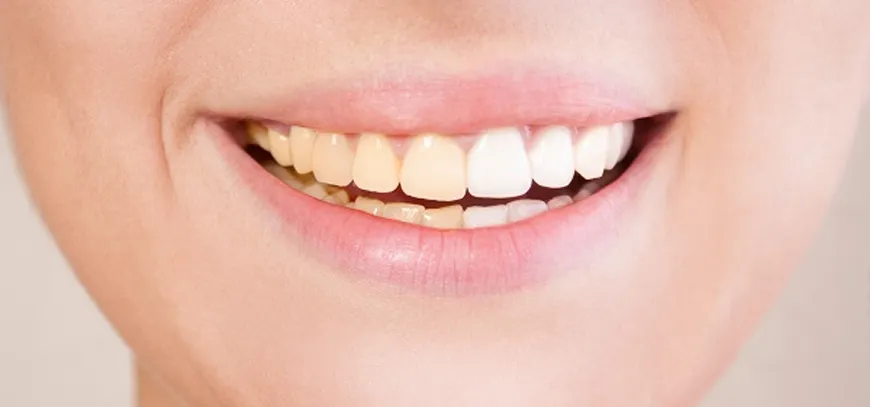 Teeth-Whitening