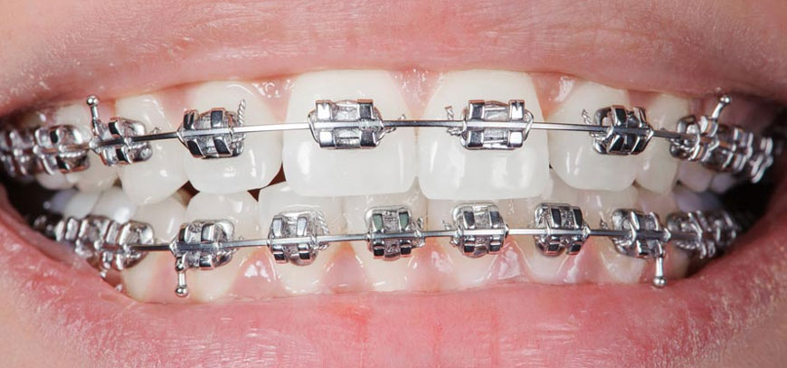 braces